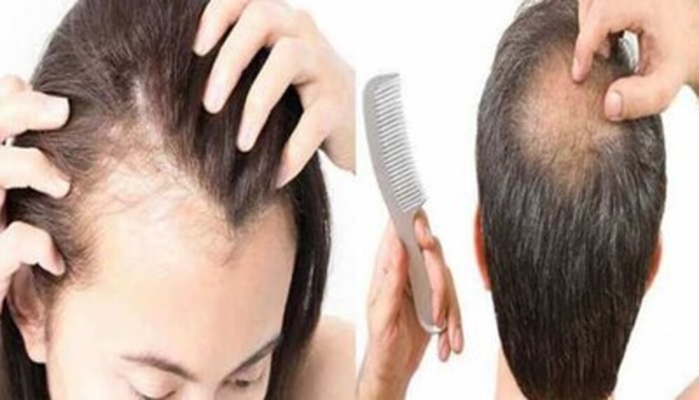 Hair Fall: इन तीन ग्रहों की कुंडली में असंतुलन से बाल झड़ते हैं