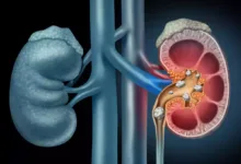 How To Keep Kidney Healthy: पथरी या किडनी की बीमारी का रामबाण इलाज,  तेजी से मिलेगा फायदा