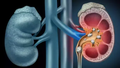 How To Keep Kidney Healthy: पथरी या किडनी की बीमारी का रामबाण इलाज,  तेजी से मिलेगा फायदा