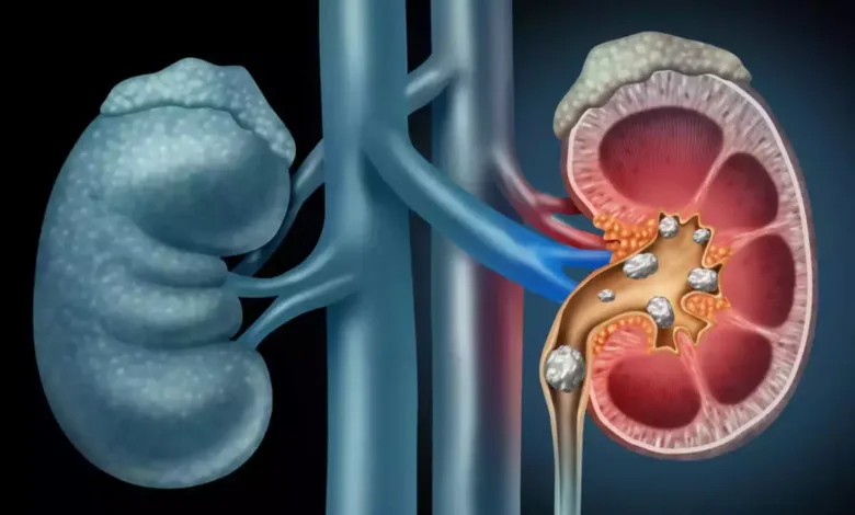 How To Keep Kidney Healthy: पथरी या किडनी की बीमारी का रामबाण इलाज,  तेजी से मिलेगा फायदा