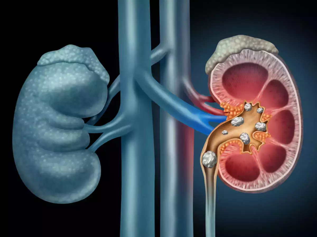 How To Keep Kidney Healthy: पथरी या किडनी की बीमारी का रामबाण इलाज,  तेजी से मिलेगा फायदा