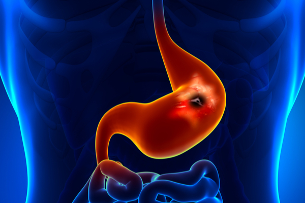 Stomach Ulcer: क्यों होता है पेट में अल्सर, अल्सर को कैसे नियंत्रित करें