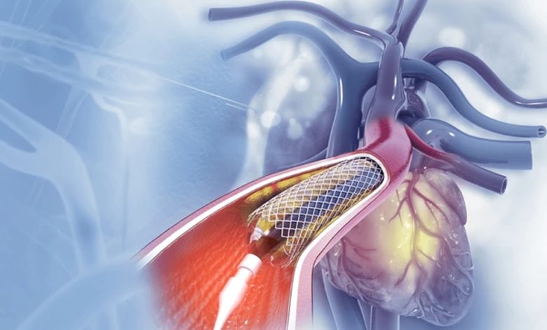 Heart Health: डॉक्टर कब हार्ट बाईपास सर्जरी करते हैं और क्या एंजियोप्लास्टी ही हार्ट अटैक के खतरे को कम कर सकता है? 1 Heart Health: डॉक्टर कब हार्ट बाईपास सर्जरी करते हैं और क्या एंजियोप्लास्टी ही हार्ट अटैक के खतरे को कम कर सकता है?