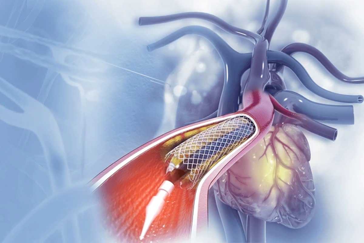 Heart Health: डॉक्टर कब हार्ट बाईपास सर्जरी करते हैं और क्या एंजियोप्लास्टी ही हार्ट अटैक के खतरे को कम कर सकता है?