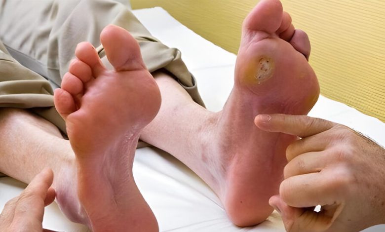 Diabetic Foot: मधुमेह के मरीजों को पैरों में ये समस्याएं हो सकती हैं, जानिए कैसे शुरू होती हैं डायबिटिक फुट