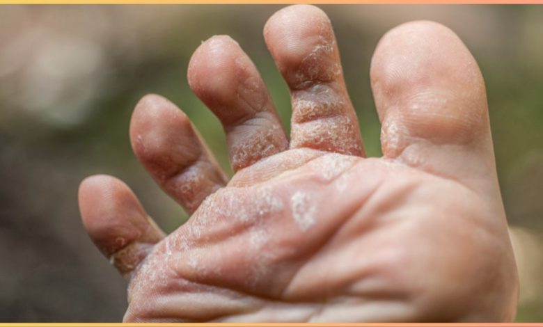 किस विटामिन की कमी से Fungal Infection होता है? डेफिशिएंसी कम करने का तरीका जानें