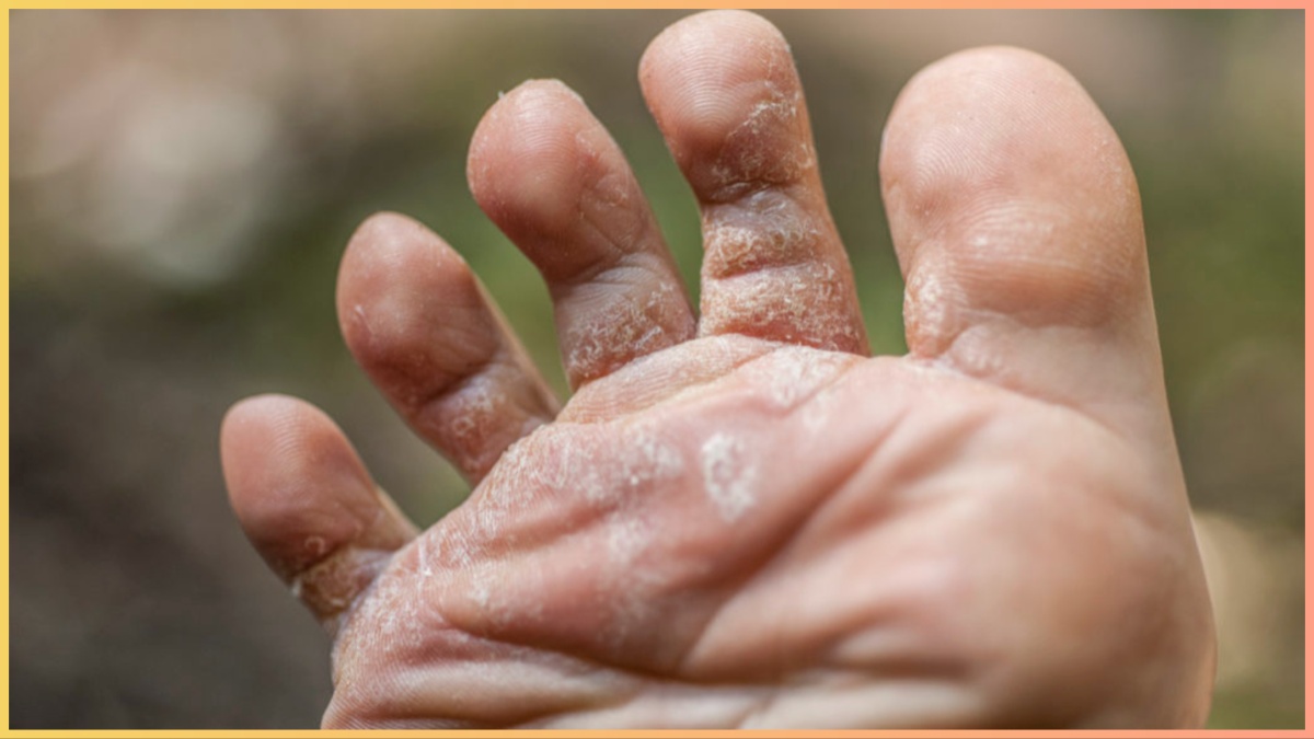 किस विटामिन की कमी से Fungal Infection होता है? डेफिशिएंसी कम करने का तरीका जानें 12 किस विटामिन की कमी से Fungal Infection होता है? डेफिशिएंसी कम करने का तरीका जानें