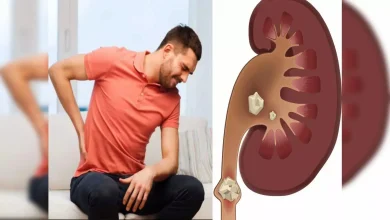 Kidney Stones: एक्सपर्ट बताते हैं कि गर्मियों में किडनी स्टोन का खतरा बढ़ जाता है, जानें समाधान का तरीका