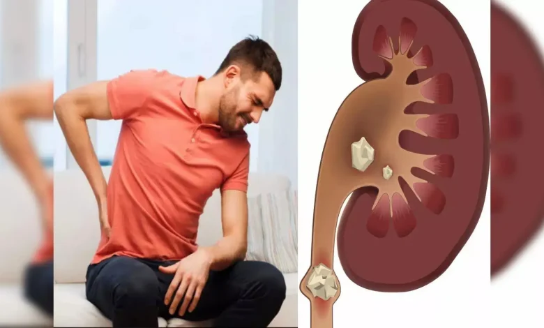 Kidney Stones: एक्सपर्ट बताते हैं कि गर्मियों में किडनी स्टोन का खतरा बढ़ जाता है, जानें समाधान का तरीका