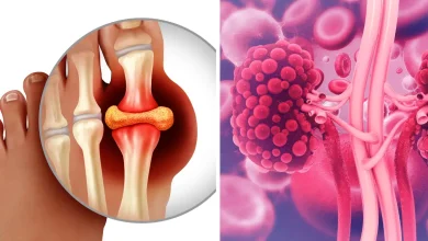 क्या High Uric Acid किडनी को नुकसान पहुंचाता है? जानें, यूरिक एसिड को प्राकृतिक रूप से कैसे नियंत्रित करें?