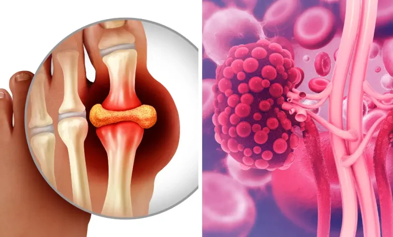 क्या High Uric Acid किडनी को नुकसान पहुंचाता है? जानें, यूरिक एसिड को प्राकृतिक रूप से कैसे नियंत्रित करें?