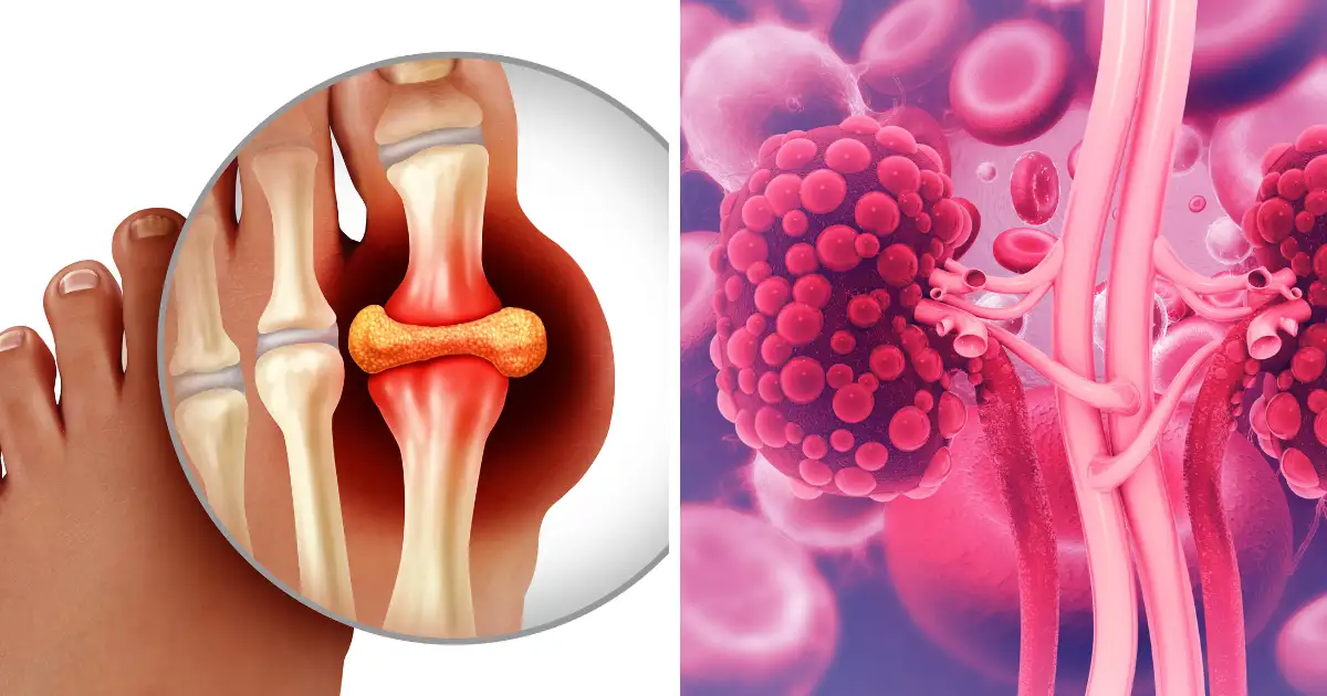 क्या High Uric Acid किडनी को नुकसान पहुंचाता है? जानें, यूरिक एसिड को प्राकृतिक रूप से कैसे नियंत्रित करें?
