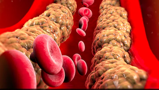 Cholesterol को कम करने के घरेलू उपाय, लक्षण दिखाई देते ही इन चीजों को अपनी डाइट में शामिल करें