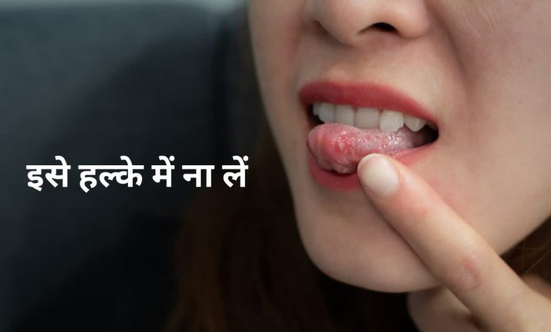 बार-बार मुंह में छाले क्यों होते हैं? जानिए किस विटामिन की कमी से जुड़ी समस्या और उपाय