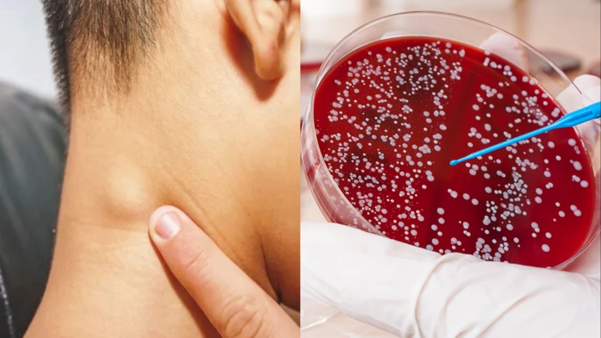 ब्लड कैंसर के प्रकार, लक्षण और बचाव के उपाय; एक्सपर्ट से जानें पूरी जानकारी