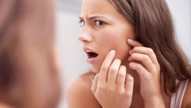 कील-मुंहासों के निशान: चेहरे के गड्ढों को भरने के आसान और असरदार तरीके