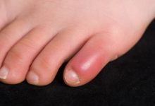 रेनाड्स सिंड्रोम लक्षण: ठंड में नीली पड़ती हैं उंगलियां? जानें शरीर में किस चीज़ की होती है कमी और कैसे बचें