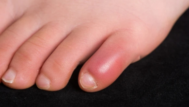 रेनाड्स सिंड्रोम लक्षण: ठंड में नीली पड़ती हैं उंगलियां? जानें शरीर में किस चीज़ की होती है कमी और कैसे बचें