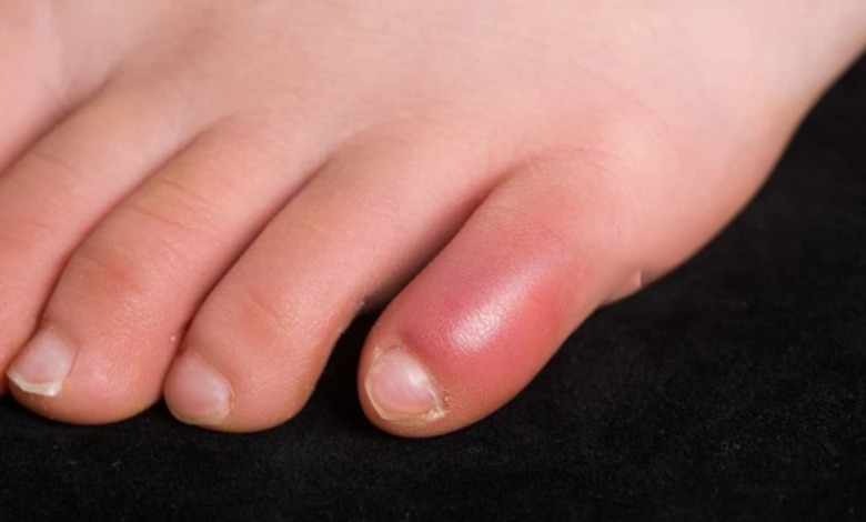 रेनाड्स सिंड्रोम लक्षण: ठंड में नीली पड़ती हैं उंगलियां? जानें शरीर में किस चीज़ की होती है कमी और कैसे बचें