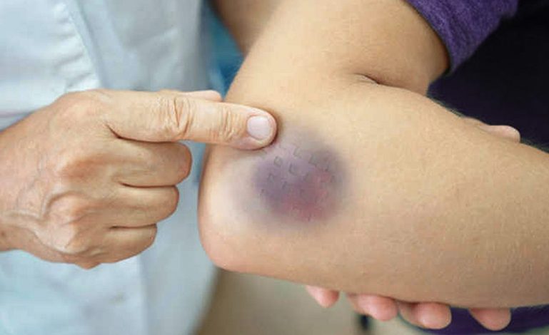 Blue Bruises on Body: बिना चोट के क्यों दिखते हैं नीले निशान? जानें इसके कारण और संकेत