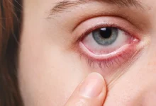 आंखों में खुजली, लालिमा और पलकों पर पपड़ी जमने की समस्या